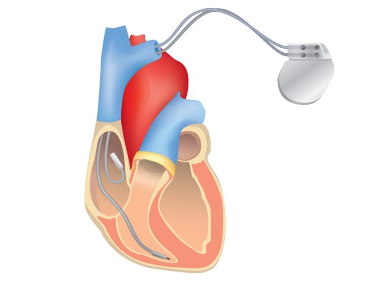 The Different Types of ICDs | My Rhythm Device