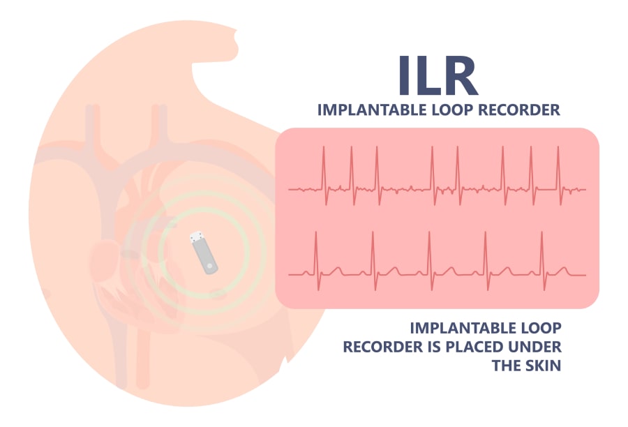 Implantable Heart Rhythm Monitor My Rhythm Device 9045