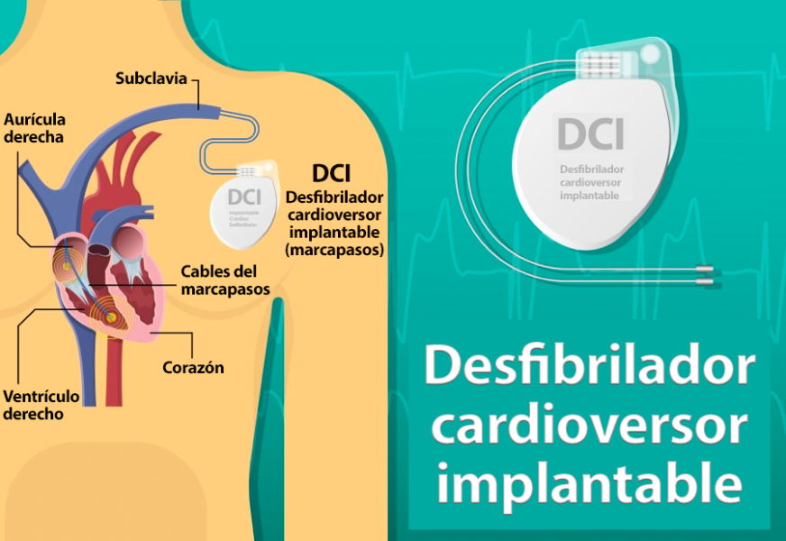 Implantación del DAI | My Rhythm Device